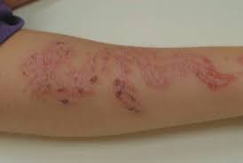 Allergy to any component of tubersol or an. Allergiegefahr Durch Kleine Farbmolekule 2012 Wiley Analytical Science