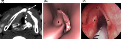 A dashboard knee injury doesn't only happen in automobile accidents. Arytenoid Luxation Following Dashboard Injury A Axial Image Shows Download Scientific Diagram