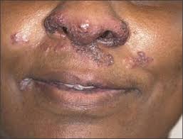Doi as a result, sarcoidosis is now defined as a multisystem disorder with a heightened cellular immune. Papules And Plaques On The Nose Photo Quiz American Family Physician