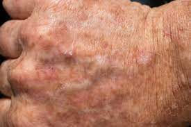 skin cancer, like all cancer, is the uncontrolled growth. Actinic Keratosis Ocean Drive Dermatology Vero Beach