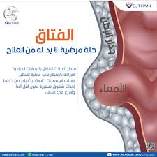 مخرج انتقال التدخل الفتق عند النساء بالصور dsvdedommel com