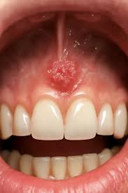 Image result for Canker sores symptoms roof of the mouth
