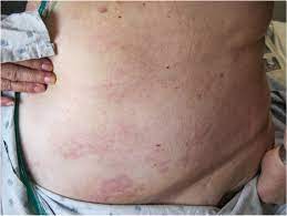 Ibc is different from other forms of breast cancer because it may not cause a lump or tumor. A Persistent Rash On The Back Chest And Abdomen Photo Quiz American Family Physician