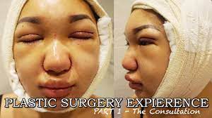 Mbbs (madras), ms (plastic surgery, usm), am (mal) fellowship in burns, laser & aesthetic surgery (taiwan) consultant plastic. My Plastic Surgery Expierence Pt 1 Double Eyelid Surgery Asian Rhinoplasty Chin Liposuction Youtube