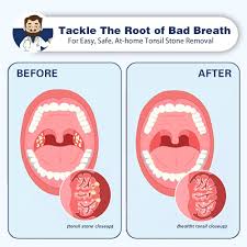 Image result for Tonsillolith