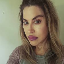 This is a before & after photo from 1902 showing the result of cheek filler  (paraffin) in a female patient. This is 100 years before modern fillers, 80  years before the first