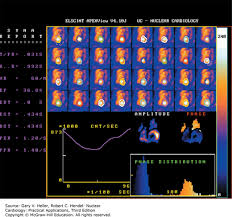 Image result for Nuclear Ventriculogram