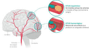 Algunas veces, se denomina ataque cerebral. Accidente Cerebrovascular Ictus