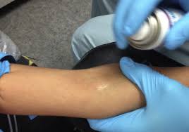 An alternative to subcutaneous injection of local anesthetic solution. Topical Refrigerant Spray For Pediatric Venipuncture For Outpatient Surgery Sciencedirect