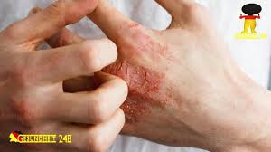 Dyshidrose Dyshidrosis Youtube