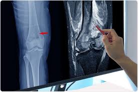 Image result for Osteosarcoma