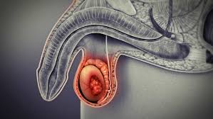 'it sort of stuck with me,' said john. Testicular Cancer Symptoms Causes Lump Survival Rate Treatment