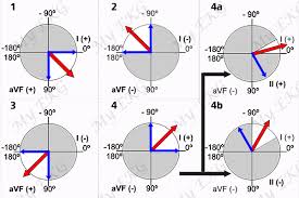 Heart Axis Calculation