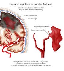 Emorragia cerebrale / emorragia subaracnoidea. Manuali Di Medicina Intensiva Emorragia Intra Parenchimale Capitolo 1 5 1