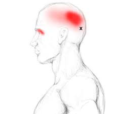 Frontalis Und Occipitalis Schmerzen Triggerpunkte Selbst Behandeln