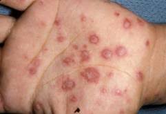 Image result for Erythema Multiforme