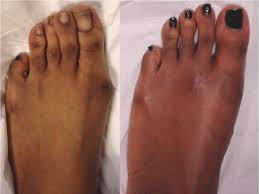 The ability to walk immediately after bunion surgery without pain should not be underestimated! Bunion Surgery