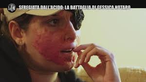 She was the victim of a disfiguring acid attack in january 2017 and has used the incident to advocate for victims of domestic violence. Gessica Notaro L Ex Che L Ha Sfregiata Con L Acido Voleva Cancellarle L Identita Le Iene