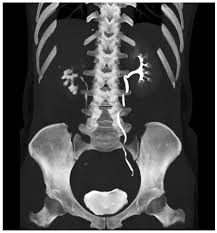 Image result for Genitourinary Tuberculosis