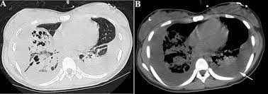Morbidity and mortality are high and chronic sequelae are frequent. Community Acquired Necrotizing Pneumonia Caused By Methicillin Resistant Staphylococcus Aureus Producing Panton Valentine Leukocidin In A Chinese Teenager Case Report And Literature Review Sciencedirect
