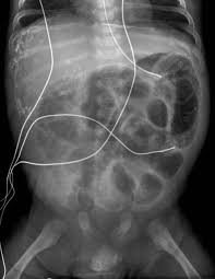 Meconium Peritonitis Radiology Case Radiopaedia Org Radiology Radiology Imaging Pediatric Radiology