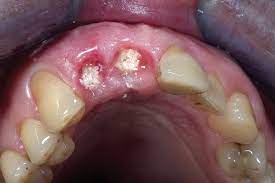 Bone grafting, normally a minor surgical procedure done in the dental office. Bone Grafts For Implant Dentistry The Basics Oral Health Group