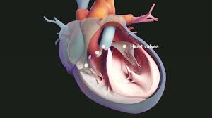 Mitral stenosis is most commonly due to rheumatic. Mitral Stenosis Heart And Blood Vessel Disorders Merck Manuals Consumer Version