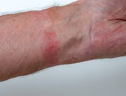 Image result for contact dermatitis
