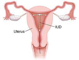 Every celebrity to rally behind britney spears after. Birth Control Iud Intrauterine Device Saint Luke S Health System