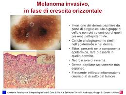 Abbiamo deciso di fornire gratuitamente una terapia che non viene rimborsato dal sistema sanitario nazionale ai pazienti affetti da melanoma con metastasi cerebrali. Melanomi Correlazioni Clinico Patologiche E Linfonodo Sentinella Ppt Scaricare