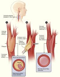 Image result for carotid artery