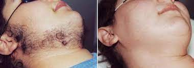 In this article, we discuss how exactly laser hair removal can help with hirsutism, and why it might be a better option compared to medical treatments. Pcos And Laser Hair Removal Inkfree Md Laser Clinic