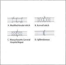 Here we discuss the equipment required. Hand And Forearm Tendon Injuries Plastic Surgery Key