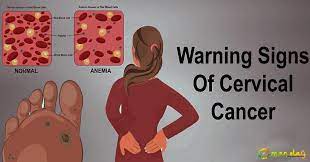 It may be detected on pap screening and cervical cancer may not produce any symptoms or signs. Warning Women Never Ignore These 7 Signs Of Cervical Cancer