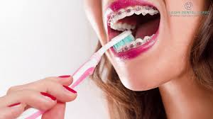 How to brush the teeth with braces. How To Brush Your Teeth With Braces Lasry Dental Clinic