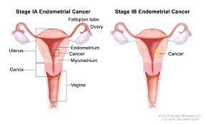 For younger women, abnormal bleeding may include periods that are heavier than usual spotting (bleeding between periods) Endometrial Cancer Hematology Oncology Associates Of Cny