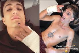 Cosa è successo alla mano di Damiano: il cantante dei Maneskin con la mano  fasciata