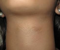 Image result for Hypertrichosis