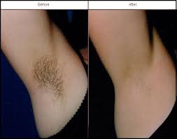 The best hair removal products can help you get rid of unwanted body hair. Say Goodbye To Hairy Underarms Schedule An Appointment With Us Today Www Capitallaser Net Laser Laser Hair Removal Cost Best Hair Removal Cream Hair Removal