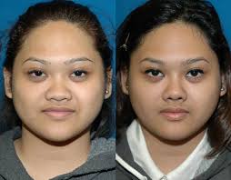 Asian Rhinoplasty Seattle Asian Rhinoplasty Bellevue Asian Nose Job Surgery