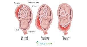 The cervix or cervix uteri (latin, 'neck of the uterus') is the lower part of the uterus in the human female reproductive system. Placenta Previa Abruptio Placentae Symptoms Possible Complications And Risk Factors Babycenter