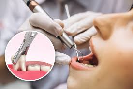 Image result for Tooth Extraction