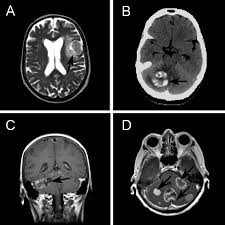Brain Metastases From Epithelial Ovarian Cancer Overview And Optimal Management Anticancer Research