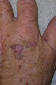 Together we will beat cancer this leaflet contains information on how to spot the symptoms of skin cancer early and reduce your risk. Skin Cancers Of The Hand And Upper Extremity Sciencedirect