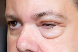 Zur kühlung der augen verwendet man ein feuchtes tuch, kühlpads, eiswürfel oder eine kühlbrille. Augenschwellungen Geschwollene Augen Lidodem Heilpraxis
