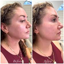 Look out! 👀 Things are happening over here! We have some new treatments  available to you so soon Including the Toskani MED Salmon DNA Facial.  Polynucleotides from salmon DNA, supports cell repair