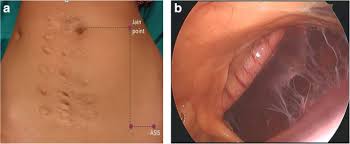 © royal college of obstetricians and gynaecologists  palmer's point is the preferred alternative trocar insertion site, except in cases of previous surgery in this area or splenomegaly. A Retrospective Study Of A Novel Non Umbilical Laparoscopic Entry Port In Thin Patients Jain Point Gynecological Surgery Full Text