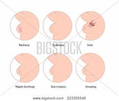 Many of the breast cancers are diagnosed much earlier than they can produce any symptoms. Early Symptoms Breast Vector Photo Free Trial Bigstock