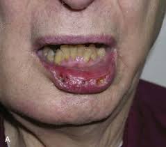 But by then, you won&#x27;t just have peeling skin; Lip Cancer Ablative And Reconstructive Surgery Pocket Dentistry