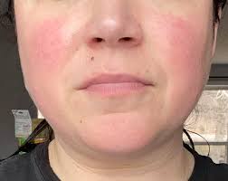 Do people randomly get rashes and flushed hot cheeks? Feels like my cheeks  are